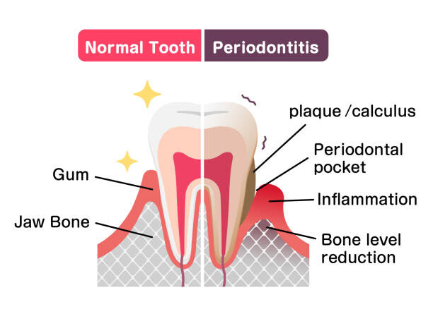 Bild auf Leinwand Comparison of normal teeth and periodontal