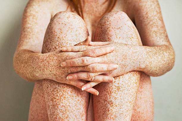 Plakát Freckled girls hands, arms and legs, close up